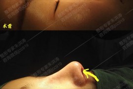 鼻翼變短視頻教程鼻子怎么變小